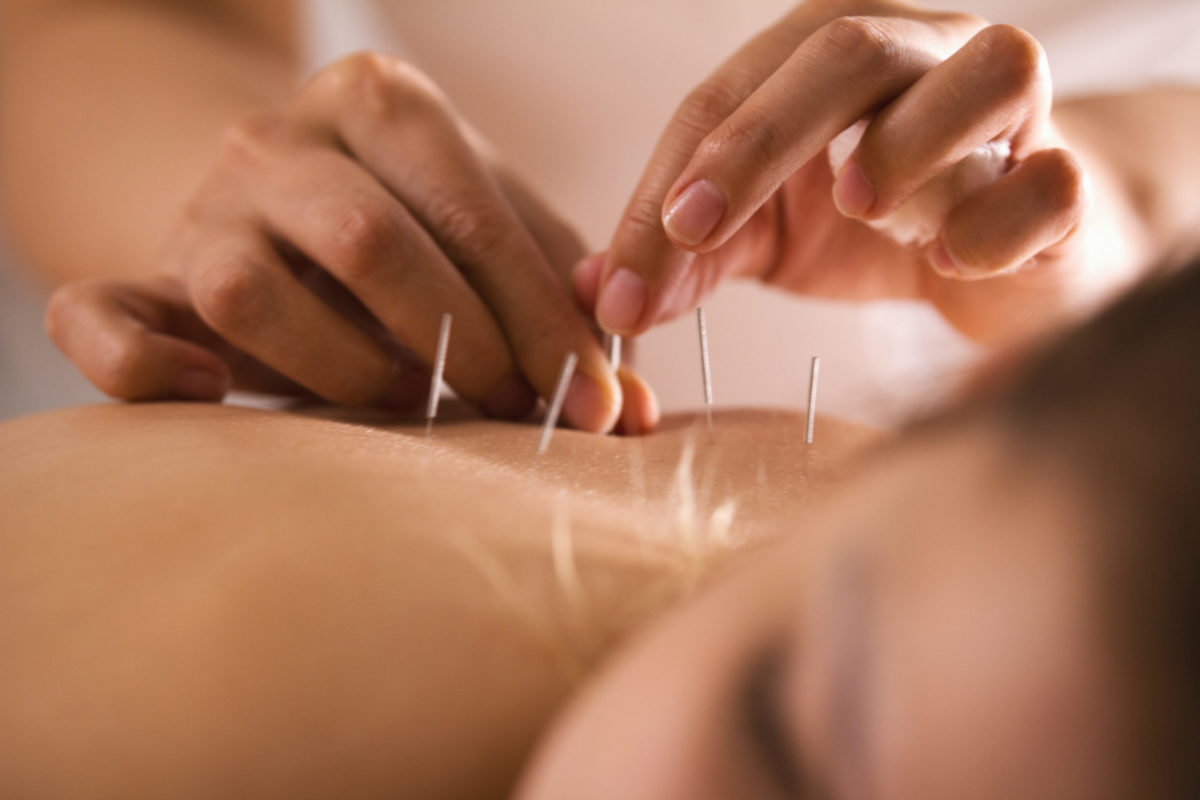 Acupuncture on Woman