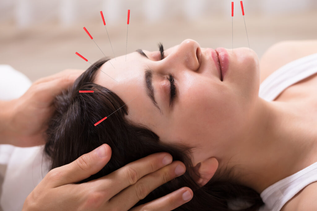 Health Benefits of Facial Acupuncture