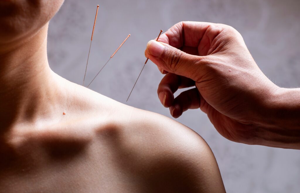 4 Benefits of Acupuncture Therapy