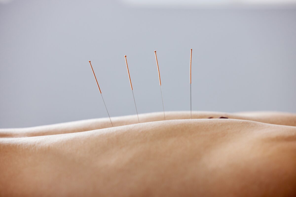 Acupuncture needles in skin on patient's spine.